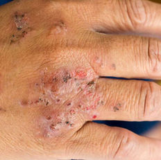 Avaderma Skin & Hair Clinic - Scabies